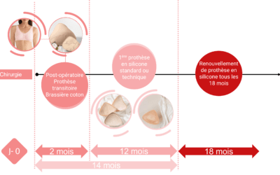 Quand renouveler sa prothèse mammaire externe